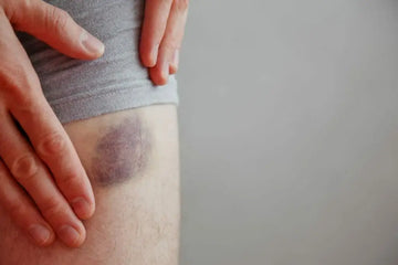 Frischer Bluterguss am Bein ohne Behandlungsaussage