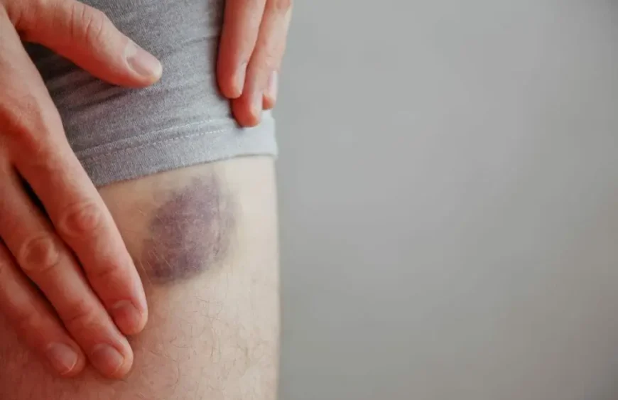 Ist es sinnvoll, einen Bluterguss zu massieren?
