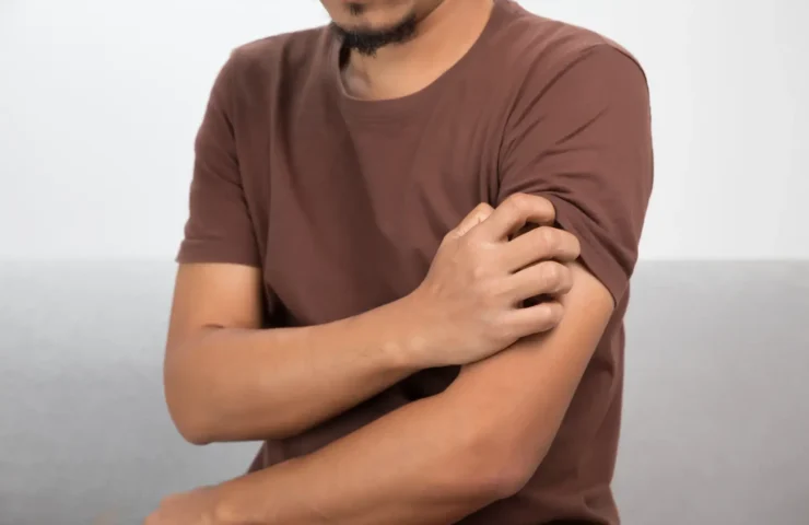 zeckenbiss juckt nach monaten