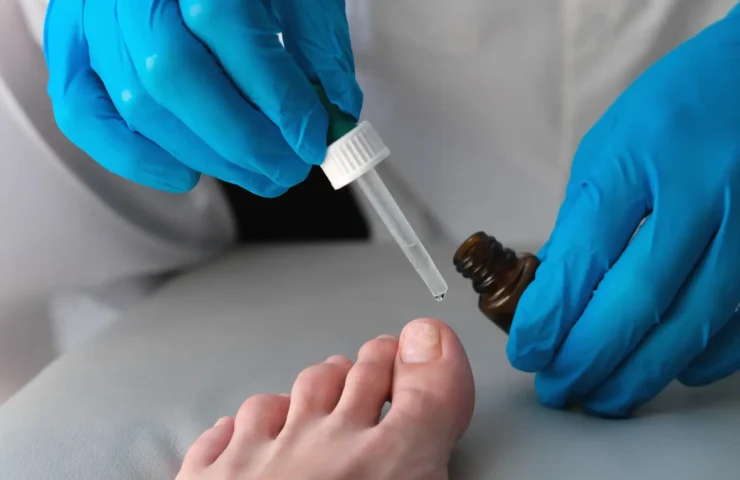 Nagelpilz, Onychomykose, schnelle Heilung, Lasertherapie, pharmazeutische Entwicklungen, Dermatologie, Hautpflege, Fußgesundheit, Pilzinfektionen, antimykotische Behandlung, Gesundheit und Wellness, medizinische Mythen, Patientenberatung, effektive Behandlungen, Heilungsprozess, Dermatologen, Studien zu Nagelpilz