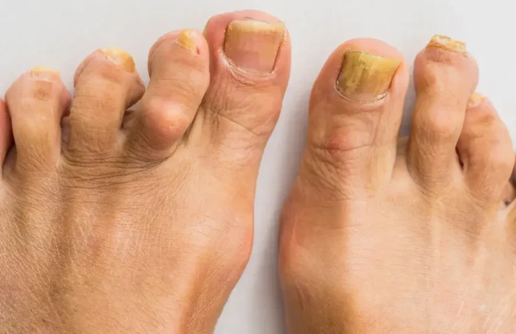 Nagelpilz Hausmittel: